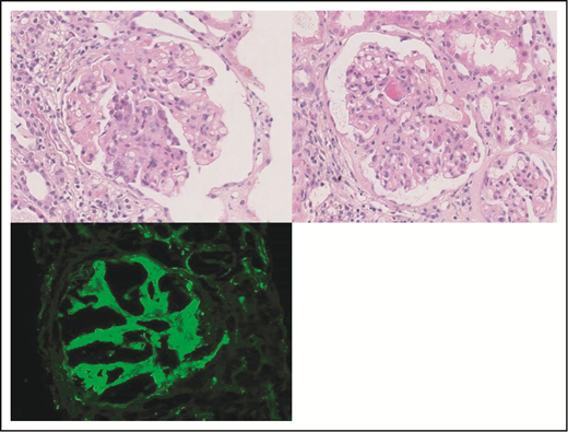Figure 6. Features of a C3GN in the setting of MGRS. Glomerulus with segmental endocapillary hypercellularity (original magnification ×400; hematoxylin & eosin stain; upper left panel). Glomerulus with segmental capillary tuft fibrinoid necrosis (original magnification ×400; hematoxylin & eosin stain; right panel). IF showed C3-dominant deposits in the mesangium and capillary loops, in keeping with a C3-dominant GN (original magnification ×400; fluorescein isothiocyanate; lower left panel).