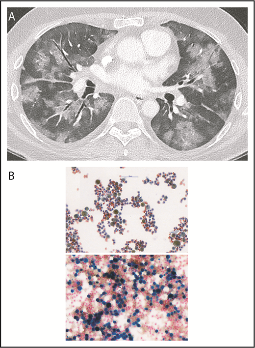 Figure 1. Diffuse alveolar hemorrhage. (A) The contrast-enhanced thoracic-computer tomography shows widespread patchy ground glass opacification and, in part, a faint “crazy paving” pattern. The contrast between the ground glass areas caused by diffuse alveolar hemorrhage and the air containing bronchi render the bronchi more prominent (dark bronchus sign). There were no signs of pulmonary embolism nor signs of active bronchial artery bleeding. (B) Images of cytological bronchoalveolar lavage specimens. (Upper) Routine Papanicolaou staining shows macrophages (50%-60%) and a significant number of neutrophils, as well as lymphocytes. Almost all macrophages contain a brown-yellow pigment in the cytoplasm. (Lower) Prussian blue staining shows an area with more prominent macrophages, of which most stain intensely blue, denoting iron, reflecting severe intra-alveolar hemorrhage (∼95% of the total macrophage population were hemosiderin-laden macrophages, Golde score 250). Magnification, 40×.