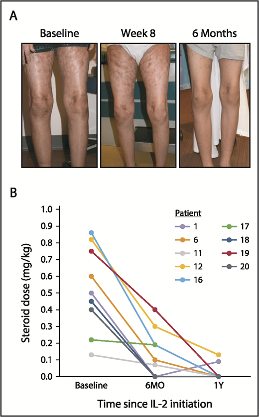Figure 3. Sclerotic skin response and change in corticosteroid doses over time in pediatric patients. (A) Sclerodermatous cGVHD of the skin in a pediatric patient (patient 16) at baseline and after 8 weeks and 6 months of low-dose IL-2 therapy. There was complete resolution of sclerotic skin by 6 months, although residual hyperpigmentation of the skin remained. Patient 1 (not shown) also had a similar skin response. (B) Change in daily corticosteroid doses (mg/kg) for pediatric patients at baseline, 6 months (6MO), and 1 year (1Y) of IL-2 therapy. Each line represents an individual patient over time.