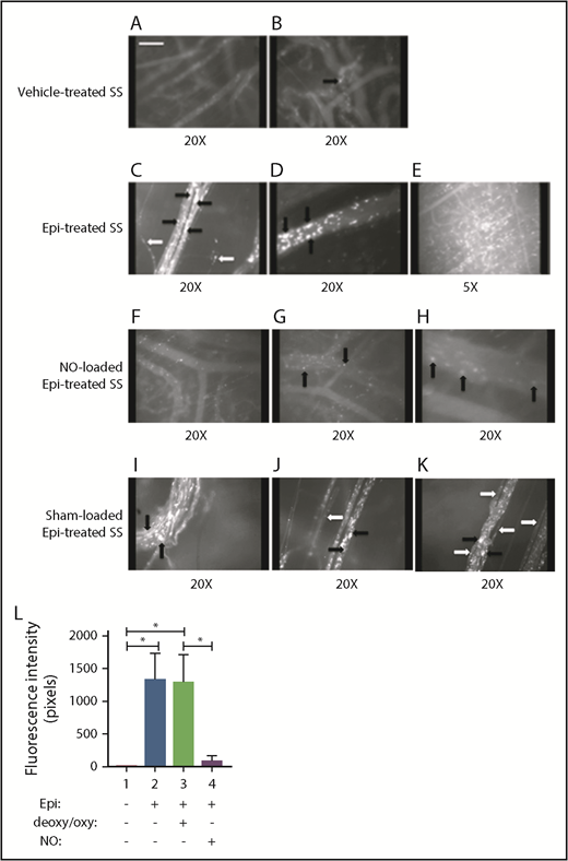 Figure 3. Replenishment of NO in SSRBCs reduces Epi-activated SSRBC adhesion to the endothelium and vessel occlusion in vivo. (A-K) Microscopic observations of postcapillary venules were conducted through implanted dorsal skin-fold window chambers after infusion of human SSRBCs into the tail vein of nude mice using 5× and 20× magnification. Vessels without adherent cells appear gray, due to the blurred fluorescence of rapidly moving SSRBCs. Infusion of vehicle-treated (n = 5; A-B), Epi-treated (n = 5; C-E), NO-loaded Epi-treated (n = 5; F-H), or sham-loaded Epi-treated (n = 5; I-K) human SSRBCs was performed. (A-E) Vehicle-treated human SSRBCs showed little adhesion to vessel walls (indicated by black arrows), whereas Epi-treated human SSRBCs showed marked adhesion to postcapillary venules, as indicated by black arrows, with intermittent vaso-occlusion, as indicated by white arrows. (F-K) In contrast, NO-loaded Epi-treated human SSRBCs displayed only minimal adhesion (indicated by black arrows) and no vaso-occlusion, whereas sham loading had no inhibitory effect on Epi-treated SSRBC adhesion (indicated by black arrows) and vaso-occlusion (indicated by white arrows). Scale bar, 50 μm. (L) Fluorescence intensity (pixels) represents fluorescence-labeled human SSRBC adhesion to vessel walls quantified by examining movies produced using 20× magnification. The values of segments of vessels analyzed were averaged among groups of animals to represent the mean fluorescence intensity. Error bars show SEM of 5 different experiments for each treatment. *P < .05 for either Epi-treated or sham-loaded Epi-treated vs vehicle-treated, and NO-loaded Epi-treated vs sham-loaded Epi-treated.