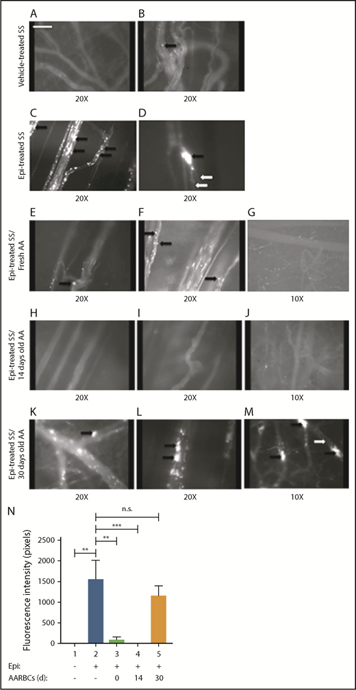 Figure 4. Banked normal AARBCs stored for 30 days failed to reduce SSRBC adhesion to the vascular endothelium and vaso-occlusion in vivo. (A-M) Microscopic observations of postcapillary venules were conducted by using 10× and 20× magnification through implanted dorsal skin-fold window chambers after infusion of human SSRBCs into the tail vein of nude mice. Vessels without adherent cells appear gray, due to the blurred fluorescence of rapidly moving SSRBCs. Mice received infusion of vehicle-treated SSRBCs, Epi-treated SSRBCs, or Epi-treated SSRBCs mixed with fresh AARBCs or AARBCs stored for 14 or 30 days. Vehicle-treated SSRBCs adhered minimally to the endothelium in vivo (A-B), whereas Epi dramatically increased SSRBC adhesion (indicated by black arrows) and vaso-occlusion (indicated by white arrows) (C-D). Infusion of either fresh (“0 day”) AARBCs mixed with epi-treated SSRBCs (E-G), or AARBCs stored for 14 days mixed with Epi-treated SSRBCs (H-J), dramatically reduced SSRBC adhesion and vascular stasis compared with Epi-stimulated SSRBCs alone. In contrast, admixture with AARBCs stored for 30 days (K-M) failed to decrease adherence of Epi-activated SSRBCs to the endothelium (indicated by black arrows) and vascular occlusion (indicated by white arrows). (N) Fluorescence intensity (pixels) representative of human SSRBC adhesion to vessels. Movies (20× magnification) were used to quantify fluorescence intensity induced by adherent human SSRBCs in animals infused with fluorescence-labeled SSRBCs treated as described in panels A-M (n = 5 for each treatment). The values were averaged among groups of animals to represent the mean fluorescence intensity. Error bars show SEM. **P < .05 for Epi-treated SS vs vehicle-treated SS, and Epi-treated SS + fresh AA vs Epi-treated SS. ***P < .05 for Epi-treated SS + 14-day-old AARBCs vs Epi-treated SS.