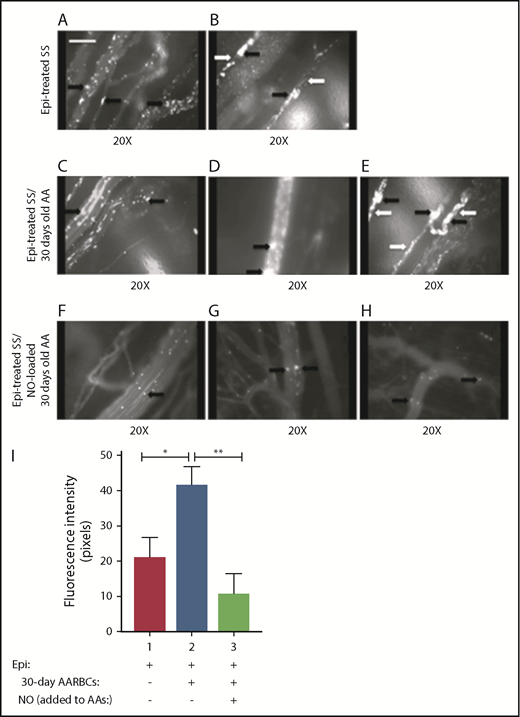 Figure 5. Loading banked (30 days old) AARBCs with NO decreased SSRBC adhesion and vaso-occlusion in vivo. (A-H) Inhibition of SSRBC adhesion with NO-loaded 30-day-old AARBCs was performed as described in "Materials and methods." Epi-treated SSRBCs (n = 5) exhibited marked adhesion to postcapillary venules, as indicated by black arrows, with intermittent vaso-occlusion as indicated by white arrows. Coinfusion with banked (30-day-old) AARBCs (n = 5) had no effect on Epi-treated SSRBC adhesion to postcapillary venules (indicated by black arrows) and vaso-occlusion (indicated by white arrows), whereas coinfusion with NO-loaded banked (30-day-old) AARBCs (n = 5) markedly inhibited adhesion of Epi-treated SSRBCs to postcapillary vessels (black arrows) with no vaso-occlusion. (I) Venule segments were analyzed by fluorescence intensity to quantify SSRBC adhesion. The values were averaged among groups of animals (n = 5 for each treatment) to represent the mean fluorescence intensity. Error bars show SEM of 5 different experiments. *P = .0207 for Epi-treated SS + old AA compared with Epi-treated SS; **P = .0046 for Epi-treated SS + old AA vs Epi-treated SS + NO-loaded old AA.