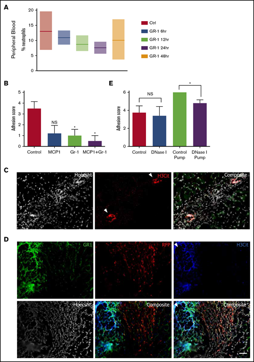 NETs play a role in adhesion induction, and depletion of NETs and neutrophils result in adhesion prevention. (A) Percentage of neutrophils in peripheral blood 6, 12, 24, and 48 hours following anti–Gr-1 administration. (B) Adhesion scoring of adhesion-induced mice treated with PBS (n = 63), Gr-1 alone (n = 4), MCP-1 alone (n = 5), and Gr-1 combined with MCP-1 (n = 14). (C) Single and composite immunofluorescence staining for H3Cit and Hoescht in adhesion tissue 7 days following adhesion induction. White arrows denote areas highly concentrated for nuclear stain and H3Cit suggestive of NETs. (D) Single and composite immunofluorescence staining for Gr-1 and H3Cit in wild-type/RFP+ parabiotic mice. (C-D) Immunofluorescence stain. Scale bar, 100 µm. (E) Adhesion scoring of adhesion-induced mice treated with intraperitoneal injections of PBS (n = 4) or DNase I (n = 5) or osmotic pumps filled with PBS (n = 5) or DNase I (n = 5). NS, not significant.
