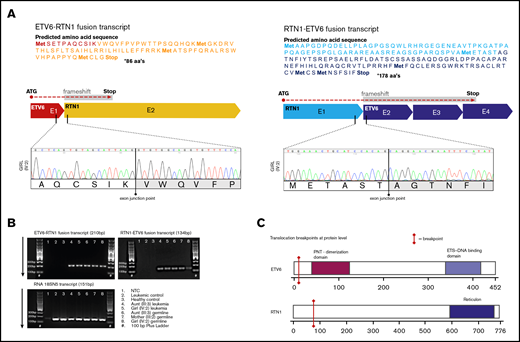 Chimeric fusion gene transcripts ETV6-RTN1 and RTN1-ETV6. (A) In silico prediction of amino acid sequences encoded by fusion transcripts. ETV6-RTN1 fusion transcript, originating from exon 1 of ETV6 and part of exon 2 of RTN1, houses a frameshift downstream of the fusion point, resulting in a premature stop codon. The transcript is predicted to encode 86 amino acids. RTN1-ETV6 fusion transcript, originating from exon 1 of RTN1 and exons 2, 3, and part of 4 of ETV6, also houses a frameshift downstream of the fusion point resulting in a premature stop codon. This transcript is predicted to encode 178 amino acids. Electropherograms of novel exon–exon junctions, resulting from the translocation, support the in silico–predicted sequences of fusion transcripts. (B) Gel images (2% agarose gel) supporting the expression of both fusion transcripts in remission and leukemia from the 2 affected female subjects (III:3 and IV:2) and germline of an unaffected carrier (III:2). Positive control ribosomal RNA 18S5N is shown in the bottom gel image. 100bp Plus DNA Ladder from GeneRuler (Thermo Fisher Scientific). (C) Two-dimensional models of ETV6 and RTN1 protein with approximate locations of breakpoints indicated by red bars. Functional domains are not retained in theoretical fusion proteins. Breakpoints are located upstream of functional domains, and all sequence downstream of breakpoints is subject to frameshift introducing premature stop codons, consequently disrupting encoded functional domains.