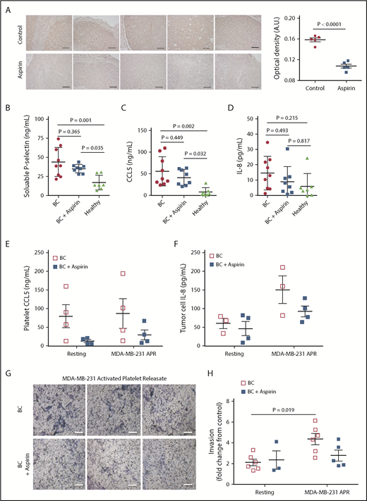 Figure 6. Patients with breast cancer receiving aspirin have decreased plasma IL-8 levels and platelets with impaired metastatic potential. (A) Tumor tissue from aspirin-treated or non-aspirin–treated (control) mice bearing MCF-7ras tumors was collected and stained for human IL-8 by immunohistochemistry. Tumors from 5 separate 100 mg/kg aspirin-treated mice and 5 control mice are shown, and semiquantitative analysis performed based on optical density. Platelets and plasma were isolated from patients with breast cancer (BC) who were either taking or not taking aspirin (81-325 mg/d). Plasma levels of soluble p-selectin (B), CCL5 (C), and IL-8 (D) were then measured by ELISA. Platelets isolated from patients were exposed to MDA-MB-231 breast tumor cells; APR was collected and used for the following: APR CCL5 measured by ELISA (E), APR was used to treat MDA-MB-231 cells for 24 hours and IL-8 secretion was measured by ELISA (F), and APR was used in Matrigel invasion assays with MDA-MB-231 cells (G-H). Scale bars represent 100 μm. P values were obtained through separate 1-way ANOVA, with post hoc Tukey’s multiple comparisons testing. n = 7 to 9 independent replicates per treatment group in panels B-D and 3 to 6 independent replicates per treatment group in panels E-F and H.
