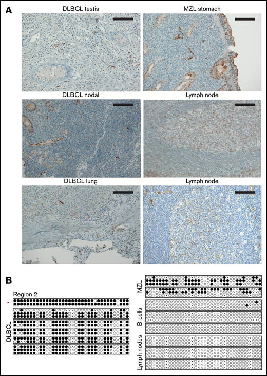 DLBCL patient samples exhibit low SMAD1 expression and high SMAD1 promoter hypermethylation. (A) Immunohistochemical SMAD1 staining of DLBCL patient samples derived from testis, lung, and lymph nodes, as well as a gastric marginal zone lymphoma (MZL) sample. Normal lymph nodes are shown as control. Scale bars, 100 μm. (B) Methylation analysis by bisulfite sequencing of region 2 within the SMAD1 promoter in DLBCL, MZL, normal B-cell, and lymph node samples. Each circle represents 1 CG dinucleotide. Each line represents 1 clone. Two or 3 clones were sequenced per sample. ●, methylated cytosine; ○, unmethylated cytosine; ×, aligned mismatches between genomic and bisulfite sequences. The red asterisk marks the patient sample that was further used for patient-derived xenotransplantation experiments in Figure 6.