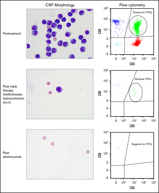CSF morphologic and flow cytometry findings during the treatment course. Pretreatment CSF showed definitive morphologic evidence of abnormal lymphocytes, with flow cytometry showing a prominent CD4 and CD8 double-positive population (green), consistent with involvement by T-PLL. Following triple therapy, the burden of disease was reduced but with persistent morphologic and flow cytometric evidence of disease. Following alemtuzumab therapy, the CSF was entirely cleared, with no morphologic or flow cytometric evidence of T-PLL (Wright Giemsa stain; original magnification ×1000).