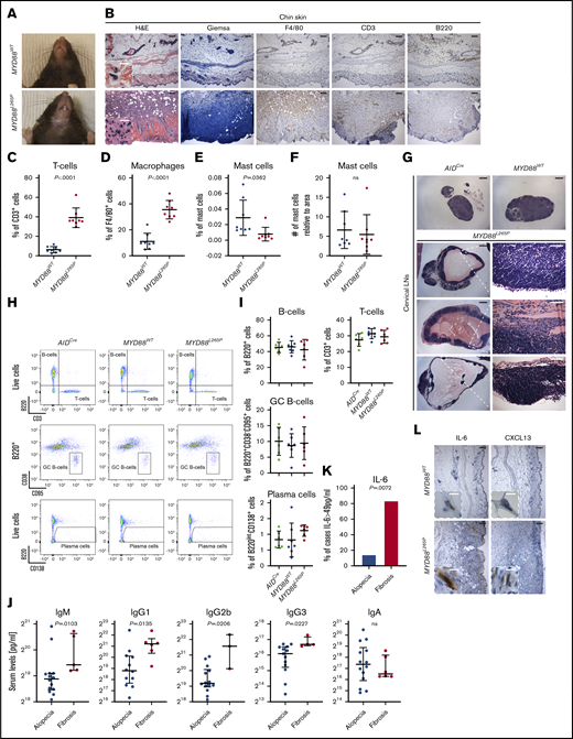 Skin, immune cell, and serum Ig changes in MYD88L265Pmice. (A) Representative gross pathology photographs of submandibular skin showing dermatitis and alopecia in MYD88L265P but not MYD88WT mice. (B) H&E, Giemsa, and IHC stains of indicated cell markers on serial submandibular skin sections from representative MYD88WT and MYD88L265P mice. Giemsa stain was used to identify mast cells; F4/80, macrophages. Scale bars: white, 10 µm; black, 100 µm. Percentage of T cells (C), macrophages (D), and mast cells (E) or number of mast cells relative to the tissue area (F) per field in the submandibular skin of MYD88WT and MYD88L265P mice. Measurements were made with inForm Cell Analysis Software analyzing 8 fields per genotype. Graphs depict the mean ± SD. P values were calculated by using Welch’s t test. (G) Histologic (H&E) analysis of representative cervical LNs demonstrating cyst development in MYD88L265P but not in AIDCre or MYD88WT mice. Scale bars: white, 50 µm; black, 500 µm. Representative density plots (H) and graphs (I) depicting the mean ± SD of flow cytometric analysis of splenic lymphoid cell subpopulations from AIDCre (n = 6), MYD88WT (n = 7), and MYD88L265P (n = 6) mice immunized with SRBCs. (J) Serum Ig concentrations assessed using multiplex immunoassay in MYD88L265P mice grouped according to severity of submandibular skin lesions. Graphs depict the median ± 25th to 75th percentile. P values were calculated by using Mann-Whitney U test. (K) Percentage of MYD88L265P mice classified by the severity of submandibular skin lesions with serum IL-6 concentrations >49 pg/mL assessed using multiplex immunoassay. P value was calculated by using Fisher’s exact test. (L) IHC stains of indicated cytokines on serial submandibular skin sections from representative MYD88WT and MYD88L265P mice. Scale bars: white, 10 µm; black, 100 µm.