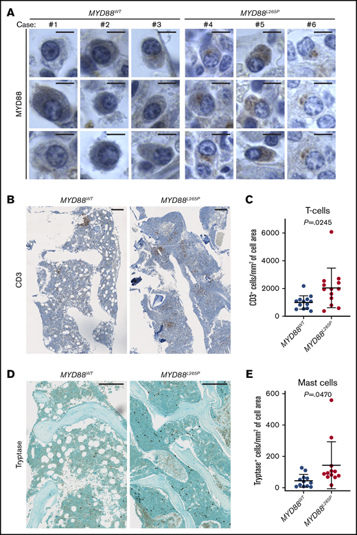 Implications of MYD88L265Pmurine model for human LPL/WM. (A) MYD88 expression in plasmacytoid lymphocytes in BM biopsies from LPL/WM patients without (n = 11) and with (n = 13) MYD88L265P mutation as evaluated by IHC staining. Three representative examples per each group are shown. Note punctate cytoplasmic staining of the MYD88L265P, but not WT, protein. Scale bars, 5 µm. T-cell infiltration of BM biopsies from LPL/WM patients without (n = 13) and with (n = 13) the MYD88L265P mutation. Representative IHC stains (B) and graphs (C) depicting the mean ± SD number of CD3+ T cells per cell annotated area (mm2) measured with HALO Image Analysis Software. Scale bars, 250 µm. P value was calculated by using Welch’s t test. Mast cell infiltration of BM biopsies from LPL/WM patients without (n = 12) and with (n = 12) the MYD88L265P mutation. Representative IHC stains (D) and graphs (E) depicting the mean ± SD number of tryptase+ mast cells per cell annotated area (mm2) measured with HALO Image Analysis Software. Scale bars, 250 µm. P value was calculated by using Welch’s t test.