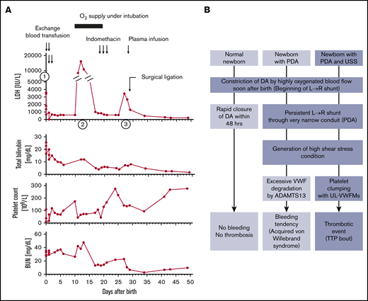Clinical course of a patient with USS (no. 16) and schematic illustration how a USS newborn with a PDA develops hemolytic jaundice and thrombocytopenia during the newborn period. (A) First episode (indicated by ①: She was born at full-term and weighed 3018 g. Nineteen hours after birth, she developed severe hemolytic jaundice and thrombocytopenia (patient no.16 in Table 1). She underwent exchange blood transfusions 4 times within the first 2 days of life. Then, she gradually developed generalized edema, and on day 8, the comorbidity of a PDA (3.8 mm in diameter) was diagnosed. Second episode (indicated by ②: On day 11, the patient developed cyanosis as a result of left cardiac failure followed by hemolysis and thrombocytopenia, so she received oxygen therapy under intubation. Third episode (indicated by ③: After clinical improvement, on days 19 to 21 she underwent intravenous administration of indomethacin with the intention of supporting PDA closure. This treatment was ineffective, and her clinical condition worsened with recurring hemolysis and thrombocytopenia on day 26. Surgical ligation of the PDA: On day 29, she underwent surgical ligation of the PDA. Thereafter, the clinical signs of hemolysis and thrombocytopenia ceased until she was 14 months old, when she had chickenpox. (B) Schematic illustration shows how a newborn with USS who has a PDA develops severe and recurring episodes of hemolytic jaundice and thrombocytopenia during the newborn period. Note that a newborn with normal ADAMTS13 activity and persisting PDA often develops acquired von Willebrand syndrome.19,20 BUN, blood urea nitrogen; LDH, lactate dehydrogenase; UL-VWFMs, unusually large VWF multimers.