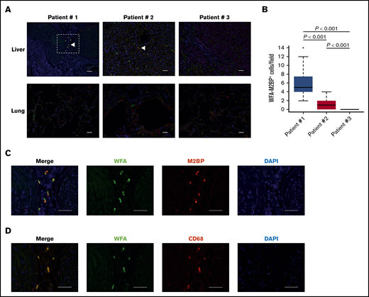 Identification of WFA+-M2BP–positive cells in immunofluorescent images. (A) Representative immunofluorescent images of WFA (green), M2BP (red), and DAPI (blue). Liver (upper panels) and lung (lower panels) sections from Patients 1, 2, and 3 are shown. WFA+-M2BP–positive cells in liver sections from Patients 1 and 2. Arrowheads point to examples of WFA+-M2BP–positive cells. Scale bars, 50 μm. (B) Quantification of WFA+-M2BP–positive cells in liver sections. The total number of WFA+-M2BP–positive cells was counted in 20 fields of view for each patient at original magnification ×200. Data are shown as box-and-whisker plots that indicate the 90th and 10th percentiles. Horizontal black lines represent median values, and circles indicate outliers. The Kruskal-Wallis nonparametric comparison with the Bonferroni adjustment was used for multiple comparisons. (C-D) Higher-magnification views of the area outlined by the dashed box in panel A. Scale bars, 50 μm. Representative immunofluorescent images of WFA (green), M2BP (red), and DAPI (blue) (C) and WFA (green), CD68 (red), and DAPI (blue) (D).