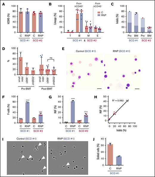 HBG1 and HBG2 promoters in CD34+HSPCs from individuals with SCD induces HbF expression in erythroid progeny generated after xenotransplantation. Plerixafor-mobilized CD34+ cells from 2 individuals with SCD (represented by blue and red) were edited with Cas9:sgRNA-1 RNP by using the Neon Transfection System. They were then transplanted into NBSGW mice via tail-vein injection. Donor-cell controls (C) were processed in parallel, but not electroporated. Donor cells were analyzed in recipient bone marrow at 16 to 18 weeks after transplantation. (A) Normalized human cell chimerism (hCD45%) in bone marrow for the 2 SCD donors. (B) Chimerism for specific human lineages in recipient bone marrow, labeled as in Figure 3B. (C) The indel fraction in CD34+ cells at 4 days after gene editing (Pre) and in bone marrow after xenotransplantation. Dark blue represents the fraction of indels with the 13-nt HPFH deletion; light blue represents all other indels. (D) Large deletions were quantified by the ΔHBG2 and Δ366+ assays (Figure 4A) in edited CD34+ cells before 16 weeks after transplantation. (E) Morphology of human CD235a+ erythroblasts in bone marrow of mice transplanted with control or RNP-edited CD34+ cells. The images were acquired using a Nikon Eclipse Ni microscope with a 60× objective and Nikon NIS-Elements software (scale bars, 10 μm). (F) The F-cell fraction in bone marrow CD235a+ erythroblasts. (G) The %HbF in CD235a+ erythroblasts isolated from recipient bone marrow, as determined by ion-exchange HPLC. (H) The correlation of the %indels with the %HbF in CD235a+ erythroblasts isolated from recipient bone marrow. (I) Human erythroblasts isolated from mouse recipient bone marrow were incubated for 8 hours in 2% O2 and visualized by phase-contrast microscopy using the IncuCyte S3 Live-Cell Analysis System (Sartorius) with a 20× objective. The white arrowheads indicate cells with sickle-like morphology. (J) The sickled cell fraction after hypoxia in edited and control cells was determined by analyzing micrographs such as those in panel I. More than 300 cells in 2 independent experiments were scored by 2 blinded observers. All bar charts show data as the mean ± SD. Each dot represents a single recipient mouse from donor 1 (blue) or 2 (red). ****P < .0001, ***P < .001, **P < .01, and *P < .05 (by unpaired Student t test).