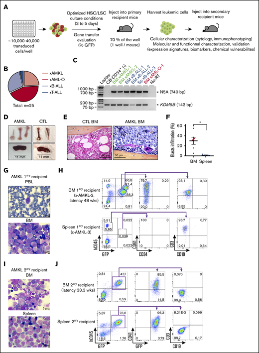 Overexpression of N5A fusion in CB-CD34+cells induces acute megakaryoblastic leukemia and multilineage leukemia subtypes in xenograft models. (A) Representation of the experimental procedures used to establish in vivo models of N5A-driven leukemia. Human CD34+ cells were isolated from CB and transduced as described in Figure 1A. After GT evaluation, 70% of the cells from each well were injected into a primary recipient mouse. Leukemia xenograft cells were collected and characterized phenotypically, molecularly, and functionally. (B) Distribution of generated xenograft models classified by leukemia subtypes based on molecular markers and cytology analyses (supplemental Table 3). Models originated from 6 experimental groups initiated from 7 independent CB samples (supplemental Table 2). (C) Detection of N5A fusion transcript expression by RT-PCR with RNA isolated from BM or spleen (Sp) cells of leukemic mice, as indicated. Normal nontransduced CB-CD34+ sample was used as negative control (CTL). (D-J) AMKL xenograft models. (D) Brittle white bones and mild splenomegaly were observed in AMKL xenograft models (xAMKL-3, N5A vector) compared with control xenograft-recipient mice (CTL, empty vector). (E) Representative hematoxylin-phloxine-saffron–stained longitudinal sections of tibia BM harvested from xCTL and xAMKL-3 recipient mice. (F) Blasts infiltration percentage (hCD45lowCD41+/CD61+ cells) in BM and spleen of primary AMKL (n = 6). (G) Giemsa-stained peripheral blood (PBL) smear and BM cytospin from an AMKL primary (1ary) recipient mouse (xAMKL-3) highlighting the presence of leukemic blasts (48 weeks after transplantation). (H) Fluorescence-activated cell sorting (FACS) profiles revealing typical hCD45lowCD34−CD41+ megakaryoblasts in the BM of a primary recipient mouse (xAMKL-3), along with CD45hiCD3+-activated T cells. The spleen is infiltrated by CD45hiCD3+ activated T cells with hCD45lowCD34−CD41+ barely detectable. Characterization of an additional mouse xenograft model (xAMKL-1) with detailed T-cell immunophenotype is shown in supplemental Figure 2. (I) Giemsa-stained BM cytospin and spleen touch preparations showing leukemic blasts derived from a secondary (2ary) recipient mouse with a 2.2 × 106 xAMKL-3 BM–cell transplant (33 weeks after transplantation). (J) FACS profiles revealing hCD45lowCD34−CD41+GFP+ megakaryoblasts in the BM and spleen of the secondary recipient mouse. *P < .05. HSC, hemopoietic stem cell; LSC, leukemic stem cell.
