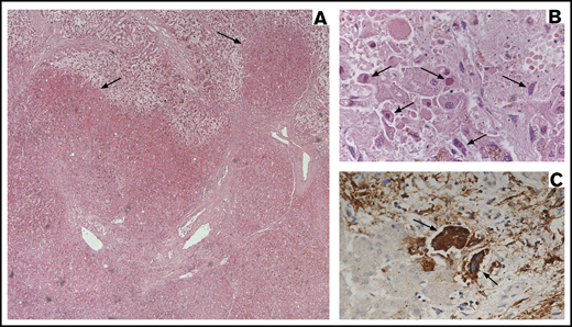 Images corresponding to illustrative case 1 (missed viral disease). (A) Low-power view (original magnification ×4) of the liver with hematoxylin and eosin stain showing extensive hemorrhagic necrosis (arrows) in a background of micronodular cirrhosis. (B) High-power view (original magnification ×60) of the liver with hematoxylin and eosin stain demonstrating prominent viral cytopathic changes with eosinophilic nuclear inclusions (arrows). (C) High-power view (original magnification ×60) of the liver with VZV immunostain demonstrating strongly positive staining of atypical multinucleated hepatic cells (arrows).