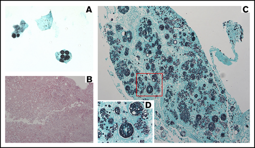 Images corresponding to illustrative case 2 (missed fungal disease). (A) BAL specimen (original magnification ×100, oil immersion) with GMS stain demonstrating dark spherical structures, originally misdiagnosed on cytopathology as P jirovecii but subsequently determined to be Coccidioides endospores. (B) Section of lung with hematoxylin and eosin stain (original magnification ×10) demonstrating a mixture of large thick-walled spherules containing variably sized endospores, diagnosed as invasive C immitis. (C) Section of lung (original magnification ×20) showing invasive C immitis as highlighted by GMS stain. (D) Magnification of area outlined in red (original magnification ×60) illustrating multiple ruptured Coccidioides spherules releasing endospores into surrounding lung tissue.