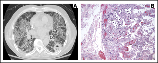 Images corresponding to illustrative case 3 (missed parasitic disease). (A) Chest CT scan demonstrating bilateral diffuse ground-glass opacities and a superimposed cavitary lesion/abscess in the left lower lobe. (B) Sections of the duodenum (original magnification ×10) with hematoxylin and eosin stain showing obliteration of the inner mucosa by S stercoralis larvae (arrows).