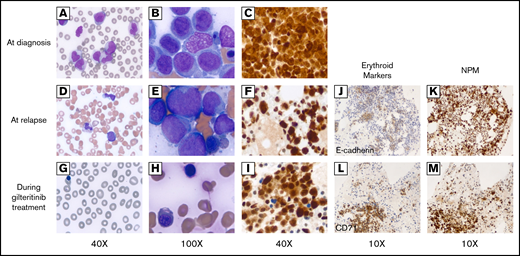 Peripheral blood smear and bone marrow biopsy before and after gilteritinib treatment. (A-C) Before gilteritinib treatment. (D-F) At relapse. (G-I) Two months after gilteritinib treatment. (A) Multiple monocytes and myeloblasts identified in peripheral blood smear (×40). (B) Clusters comprising blasts, monocytoid cells, and dysplastic normoblasts in bone marrow smear (×100). (C) NPM immunostain demonstrating both nuclear and cytoplasmic stains (×40). (D) A few monocytes and blasts in peripheral blood (×40). (E) Multiple monocytoid cells and blasts in clusters in bone marrow smear (×100). (F) Both nuclear and cytoplasmic stains by NPM immunostaining (×40). (G) Leukopenia without circulating blasts, polychromasia, and nucleated red blood cells in peripheral blood smear (×40). (H) Numerous erythroid precursors, dysplastic normoblasts identified in bone marrow smear (×100). (I) NPM immunostain redemonstrating abnormal staining pattern in both cytoplasms and nuclei (×40). (J) Erythroid precursors indicated by E-cadherin (×10) were within the distribution of NPM immunostain (×10) (K) at relapse. (L) Erythroid precursors indicated by CD71 (×10) that markedly increased after gilteritinib treatment were (M) a large proportion of NPM1-mutated cells in bone marrow.