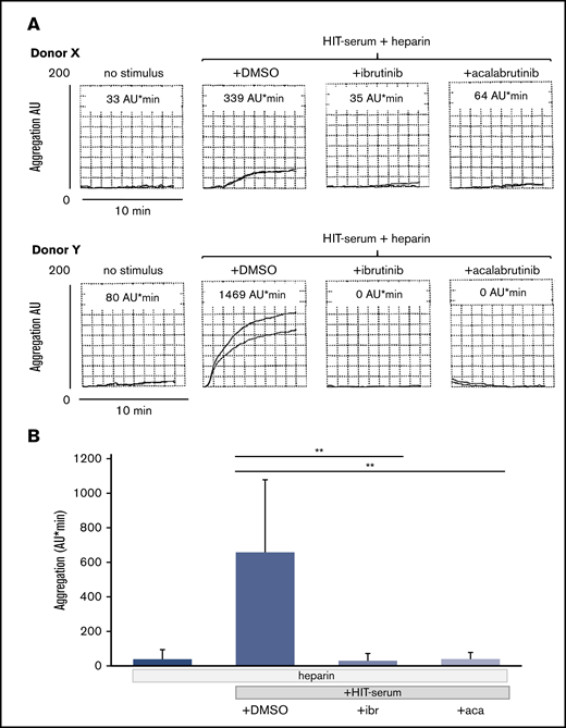 Effects of the BTKi’s ibrutinib and acalabrutinib on platelet aggregation in blood stimulated by HIT serum and heparin. Blood samples were incubated for 30 minutes with solvent (DMSO, 0.1%) or BTKi’s (ibrutinib, 0.2 µM and acalabrutinib, 1 µM) and subsequently for 30 minutes with HIT-positive serum (100 µL) before addition of heparin (0.5 U/mL) for 3 minutes and start of stirring. Aggregation was measured for 10 minutes. (A) Representative MEA tracings of 2 healthy blood donors showing the effect of BTKi's on low (donor X) and high (donor Y) platelet aggregation upon stimulation by HIT serum. The numbers above the tracings indicate cumulative aggregation values (AU/min) measured for 10 minutes. (B) Bar diagram showing the effects of BTKi's on platelet aggregation stimulated by HIT-serum and heparin. Values are mean ± SD (n = 5 different blood donors). **P < .01.