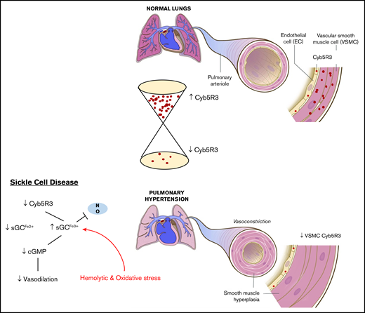 Schematic of CYB5R3 protein expression in pulmonary arterial SMCs and its effect on pulmonary artery vascular tone. Under normal conditions CYB5R3 in VSM regulates the redox state of sGC heme iron, maintaining sGC in its NO-sensitive reduced form (Fe2+), whereby signaling for cGMP production occurs and mediates vessel relaxation for low pulmonary vascular resistance. In SCD, CYB5R3 protein expression in VSM is relatively low and sGC heme iron oxidation (Fe3+) is high due to chronic hemolytic and oxidative stress. The result is “resistance” to NO signaling for cGMP production. This pathology produces a constricted pulmonary arterial phenotype, in which high vascular resistance increases pressure to drive pulmonary arterial hypertension and hyperplasia.