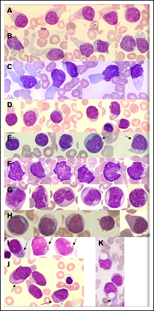 Representative morphologies of BPDCN in blood or bone marrow aspirates. (A-D) Typical morphology with large pseudopodia, microvacuoles in some blasts, an eccentrically located nucleus, and heterogeneous coloration of the cytoplasm (lightly basophile with some gray areas). The nuclei are sometimes prominent (C). (E) Lymphoid-like morphology with small cells, very small cytoplasm, and mature chromatin of the nucleus. In this case, other cells (arrows) are bigger and present a more immature profile. (F-G) Monoblast-like blasts. Cells are bigger and more basophilic, with irregular nuclei and prominent nucleoli. Case G is BPDCN secondary to acute transformation of CMML. (H) A more immature morphology with a high nucleocytoplasmic ratio, diffuse chromatin, nucleoli, and basophilic cytoplasm. (I-J) Presence of granules in the cytoplasm (arrows). (K) Atypical big and round vacuoles in the cytoplasm. May-Grünwald-Giemsa, original magnification ×1000.