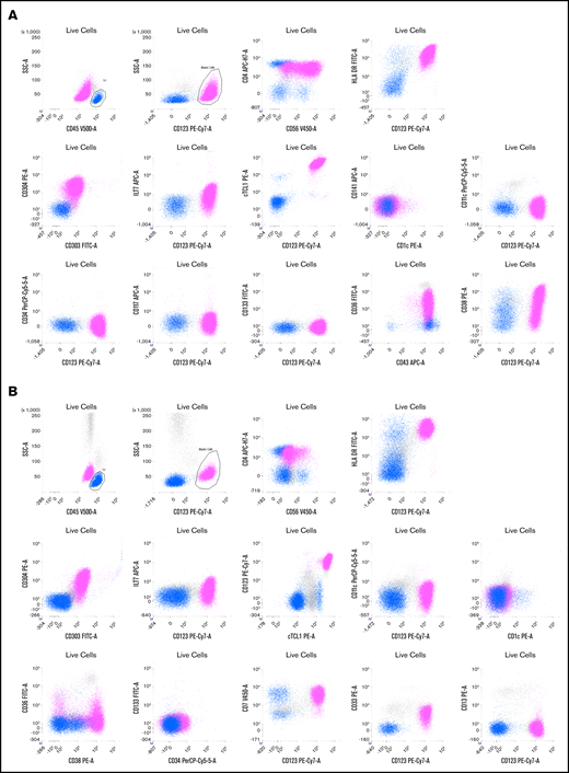 Two representative examples of BPDCN patients. Live cells are gated on a first forward scatter (FCS)/side scatter (SSC) to exclude debris and a FCS area (A)/FSC height (H) gate to select singlets (not shown). The CD45bright /SSClow cells are lymphocytes (blue), and CD45dim /CD123bright cells are a BPDCN blastic population (pink). (A) Patient P165. Blasts are CD4+ (lower than T lymphocytes in blue) and CD56+ with a bimodal expression, CD303+, CD304+ HLA-DR+, cTCL1+, ILT7low, CD36+, CD38+, and CD43+.There is no expression of classical dendritic cell markers (CD1c, CD141, and CD11c) or immature markers (CD34, CD133, and Tdt). (B) Patient P149. Blasts are CD4+ and CD56partial and low, CD303+, CD304+ HLA-DR+, cTCL1+, ILT7−, CD36−/partial, and CD38+. The blasts also expressed CD7 and CD33 without CD13. Classical dendritic cell markers (CD1c, CD141, and CD11c) and immature markers (CD34 and CD133) are negative. APC, allophycocyanin; FITC, fluorescein isothiocyanate; PE, phycoerythrin.