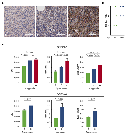 1q21-amplified MM is characterized by high MCL1 expression. (A) Representative images of low (left; 1), moderate (center; 2), and high (right; 3) MCL-1 staining of MM BM biopsies by immunohistochemistry (IHC) (original magnification ×400). (B) MCL-1 staining intensity in 1q21 WT (n = 5) and amplified (n = 6) patient samples, as determined by IHC. (C) MCL1 gene expression and MCL1/BCL2 and MCL1/BCL2L1 (BCL-XL) ratios in patients without and with 1q amplification (GSE2658: 2 copies, n = 131; 3 copies, n = 69; ≥4 copies, n = 43; and GSE6401: 2 copies, n = 37; ≥3 copies, n = 40). Ratios were calculated based on normalized gene expression values. ns, nonsignificant.