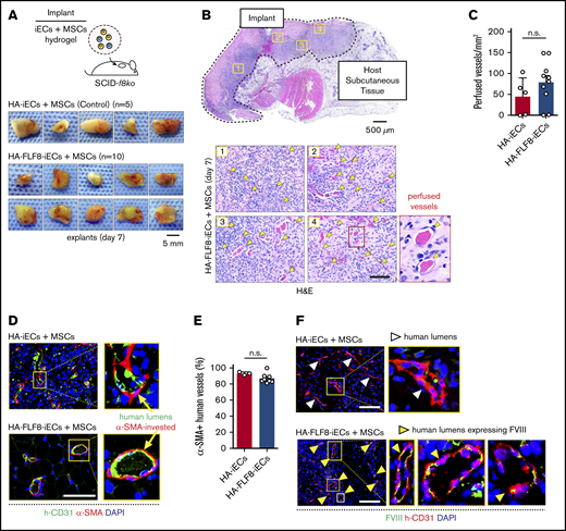Bioengineering HA-specific FVIII-secreting vascular networks in hemophilic mice. (A) Schematic of the microvascular graft model. Grafts were prepared by combining either HA-iECs (n = 5) or HA-FLF8-iECs (n = 10) with MSCs in hydrogels followed by subcutaneous injection into immunodeficient hemophilic mice (SCID-f8ko). Images are macroscopic views of the explanted grafts at day 7. (B) Hematoxylin-and-eosin (H&E) staining of a representative explanted HA-FLF8-iEC graft. Underneath, representative pictures are taken from 4 separate regions of the graft. Perfused microvessels (yellow arrows) identified as lumenal structures containing erythrocytes. (C) Comparison of microvessel density (perfused vessels per mm2) between HA-iEC and HA-F8FL-iEC implants. Bars represent mean ± SD. (D) Immunofluorescence staining of explanted grafts after 7 days in vivo. Human lumens stained by h-CD31. Perivascular coverage stained by α-SMA. Nuclei stained by DAPI. (E) Percentage of human lumens with α-SMA+ perivascular coverage in explanted grafts on day 7. Bars represent mean ± SD. (F) Immunofluorescence staining of FVIII in explanted grafts after 7 days in vivo. Human lumens stained by h-CD31. Nuclei stained by DAPI. Human vessels in grafts formed with HA-FLF8-iECs overexpressed FVIII, whereas grafts formed by unedited HA-iECs had virtually undetectable levels of FVIII. Scale bars, 5 mm (A), 500 µm (B, gross), and 100 μm (B,D,F).