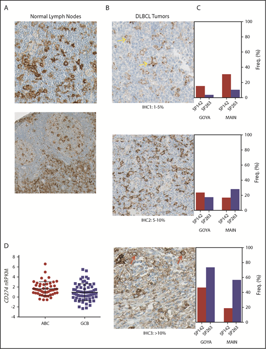 Figure 1. Similar to normal lymph nodes, PD-L1 is expressed by myeloid ICs in DLBCL, with different prevalence and intensity depending on the staining procedure. (A) Membranous immunohistochemical stain for PD-L1 protein (with hematoxylin counterstain) on cells with myeloid/dendritic morphology in normal lymph nodes (original magnification ×400). (B) Representative images of PD-L1 protein staining (SP263; original magnification ×400) among DLBCL patients treated in MAIN using a simplified IHC scoring system capturing PD-L1+ ICs or TCs (IHC 1, 1%-5%; IHC 2, 5%-10%; IHC 3, >10%). Yellow arrows represent PD-L1 staining on myeloid cells, and red arrows represent PD-L1 staining on malignant B cells. (C) PD-L1 prevalence and staining intensity among de novo DLBCL patients treated in 2 phase 3 clinical trials (MAIN, GOYA) using 2 different PD-L1 IHC reagents (SP142, SP263). (D) PD-L1 messenger RNA (mRNA) is higher in the ABC DLBCL subset (P = .004; MAIN). Freq, frequency; nRPKM, normalized reads per kilobase million.