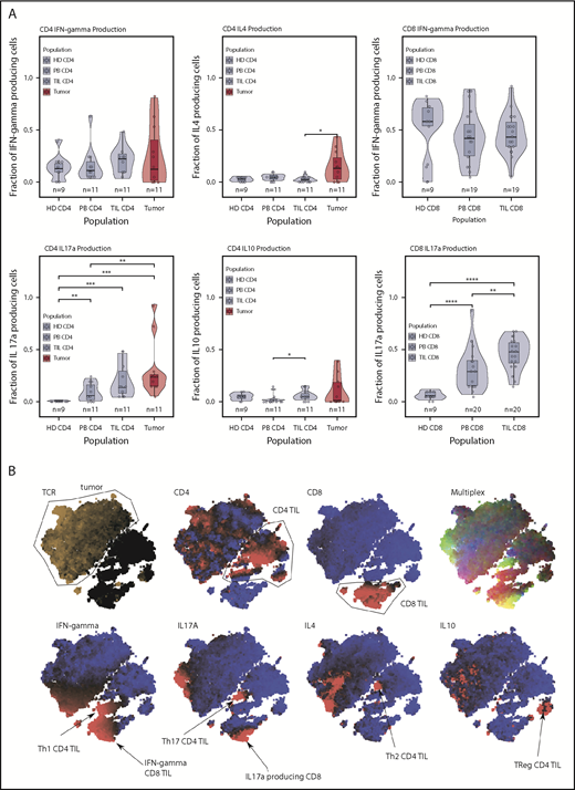 Figure 4. Cytokine production. (A) Cytokine production in the T cell subsets. Production of IL-17 was high in the microenvironment in tumors and TILs. IL-4 production was elevated only in the tumor population. Tumor and TILs were capable of producing IFN-γ. IL-10 production occurred in a handful of tumor cases, but the median IL-10 production was highest in the CD4 TIL population. (B) tSNE clustering of cytokine data, which shows the T helper cell subsets of the immune response. This tumor was a producer of IL-17 and IL-4. *P < .05; **P < .01; ***P < .001; ****P < .0001.
