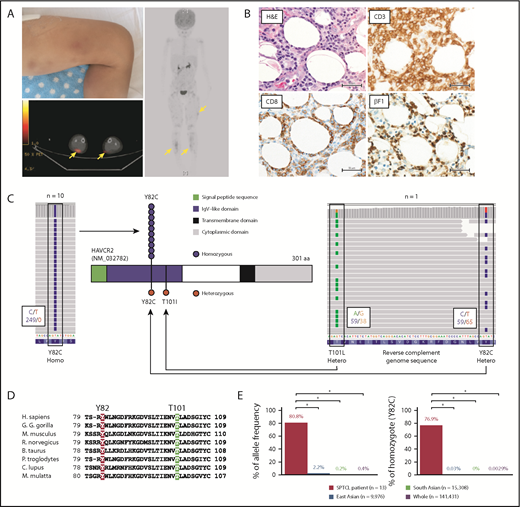 Figure 1. Individuals with biallelic HAVCR2 germline mutations are highly susceptible to SPTCL. (A) Representative images of a case with SPTCL. Multiple subcutaneous nodules with erythema diffusely involved lower legs (upper left panel). A positron emission tomography/computed tomography scan showed multiple regions with 18 fluorodeoxyglucose (FDG) uptake in subcutaneous soft tissue (yellow arrows). (B) Representative pathological images of SPTCL. On hematoxylin and eosin staining, infiltrating lymphocytes with cellular atypia-rimmed adipocytes (upper left panel). On immunohistochemical staining, these atypical cells were positive for CD3, CD8, and βF1 (TCRβF1) (lower left and right panels). Scale bars, 50 µm. (C) Germline mutations in HAVCR2 (NM_032782), encoding TIM3 protein, detected by WES. Representative images from IGV software showed homozygous p.Y82C mutation in UPN3 (left panel) and compound heterozygous p.Y82C and p.T101I mutations in UPN2 (right panel). In these images, mutated nucleotides (c.245A>G and c.302C>T as shown by reverse complementary DNA sequence) are highlighted in blue and green on sequence reads (horizontal gray bars), respectively. Larger black boxes outline the codons affected by mutations, and the smaller black boxes contain the number of bases with/without substitution, as indicated by the corresponding colors. Functional domains of TIM3, together with sites and zygosities of HAVCR2 mutations, are also shown (middle panel). Among 13 patients, 10 harbored homozygous p.Y82C (blue circles), and 1 patient harbored heterozygous p.Y82C and p.T101I (red circles). (D) Homology of the mutated residues in TIM3 protein. Alignment of amino acid sequences in immunoglobulin variable–like domain of TIM3 among different species is shown (Homo sapiens, Gorilla gorilla gorilla, Mus musculus, Rattus norvegicus, Bos taurus, Pan troglodytes, Canis lupus, and Macaca mulatta). Two residues of TIM3 mutated in SPTCL were highly conserved, as highlighted in red (Y82) and green (T101). (E) Enrichment of HAVCR2 germline mutations (p.Y82C) in SPTCL. Allele frequencies (left panel) and homozygote ratios (right panel) of p.Y82C (c.245A>G) are shown in SPTCL patients from our study, as well as from general populations from the gnomAD dataset. SPTCL patients, East Asians, South Asians, and the whole general population are indicated in red, blue, green, and purple, respectively. *P < .001, Fisher’s exact test.