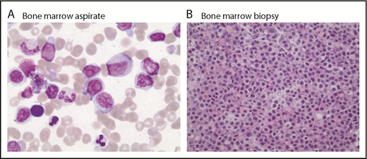 Figure 1. Bone marrow aspirate and biopsy (postibrutinib). Large cells noted on bone marrow aspirate (A; magnification ×100, Wright Giemsa stain) and (B; magnification ×40, hematoxylin and eosin stain).