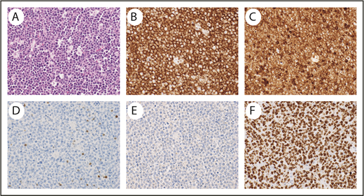 Figure 1. Representative pathology from a patient with BL. Hematoxylin and eosin stain demonstrates typical starry-sky appearance with a diffuse infiltrate of medium-sized lymphocytes and tingible-body macrophages (A), CD20 stains the malignant cells (B), CD10 stains the malignant cells (C), BCL2 is negative in the malignant cells and stains positive in background T lymphocytes (D), TdT is negative (E), and Ki67 is positive (F) in >95% of malignant cells. Magnification ×40 for all images.