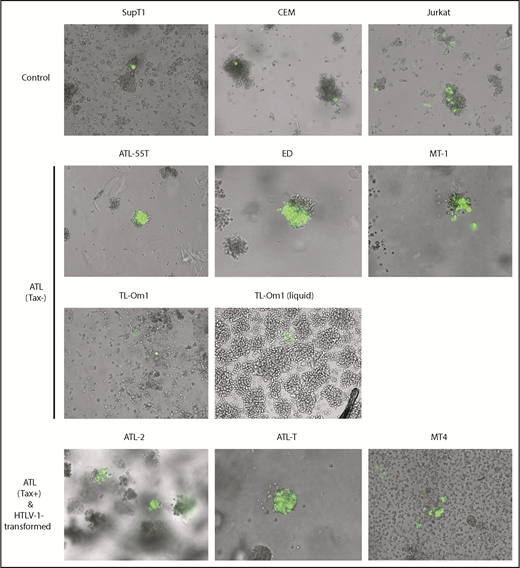 Figure 1. ATL cells are resistant to Tax-induced senescence. T cells were transduced with the HTLV-1 oncogenic protein Tax and an EGFP Tax-reporter plasmid14 and allowed to grow undisturbed for 7 to 10 days. Transduced T cells were monitored for proliferation in semisolid media, as described in “Materials and methods.” This experiment was repeated 3 times; representative images acquired using a 10× objective are shown.
