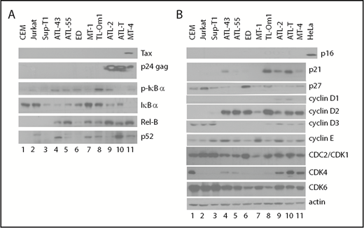 Figure 2. NF-κB activation and cell-cycle dysregulation in ATL and control T cells. Whole cell lysates were prepared as reported6 and analyzed by standard immunoblotting using the indicated antibodies. (A) Evaluation of NF-κB pathway activation. (B) Evaluation of cyclin-dependent kinase inhibitor, cyclin, and CDK expression. Each immunoblot shown used the same protein lysates; the β-actin control in panel B is applicable to panel A. Each blot was repeated ≥5 times with the same and different lysates.