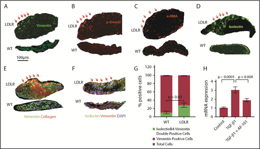Figure 5. VEC undergo mesenchymal transition. Aortic valve sections from WT and LDLR mice fed with HFD for 6 months were stained with vimentin (A), p-Smad2 (B), α-SMA (C), isolectinB4 (D), and α-1 type I collagen (E); nuclei were stained with DAPI (blue). Red arrows indicate a subset of cells expressing high levels of these markers in LDLR mice, but not WT. (F) Valve sections from WT and LDLR mice fed with HFD for 6 months were stained with vimentin and isolectinB4. (G) Quantification of double-positive (isolectinB4+vimentin), vimentin-positive cells, and total nucleated cells by counting DAPI. (H) Real-time polymerase chain reaction for Col1α1 in human umbilical vein endothelial cells stimulated with platelet-derived TGF-β1 for 3 hours, with or without anti-TGF-β1 antibody (AF-101-NA).