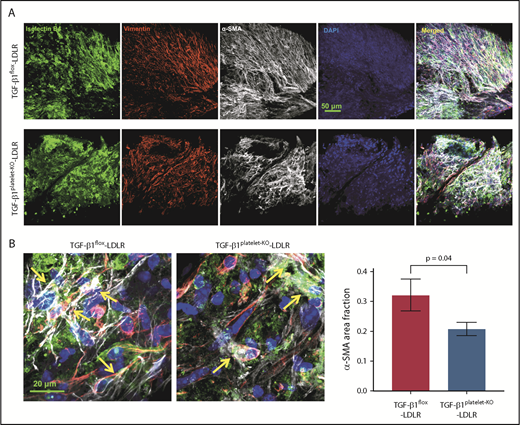 Figure 6. Platelet TGF-β1 contributes to VEC-mesenchymal transition. (A) Whole-mount aortic valve staining with isolectinB4 (green), vimentin (red), α-SMA (gray), and DAPI (blue) in littermate TGF-β1flox-LDLR control mice (top) and TGF-β1platelet-KO-LDLR mice (lower) at 6 months on HFD. (B) Higher-magnification images showing colocalization (yellow arrows) of isolectinB4, vimentin, and α-SMA in aortic valves from the 2 groups of mice. Quantification of α-SMA–positive area fraction in whole-mount images of aortic valves from TGF-β1flox-LDLR control mice and TGF-β1platelet-KO-LDLR mice after 6 months on HFD (right).