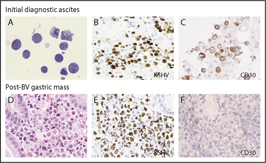 Figure 1. Microphotographs of diagnostic PEL ascites and post BV-treated gastric biopsy from patient B. Initial peritoneal fluid contained numerous large atypical lymphoid cells with irregular nuclear contours and conspicuous nucleoli (A; Diff-Quik, original magnification ×500) with immunohistochemistry demonstrating expression of KSHV by LANA (B; original magnification ×400), and CD30 (C; original magnification ×400). The new gastric mass occurring posttreatment with BV (D; hematoxylin and eosin, original magnification ×400) showed sheets of similar atypical large lymphoid cells expressing KSHV (E; original magnification ×400) but without expression of CD30 (F; original magnification ×400).