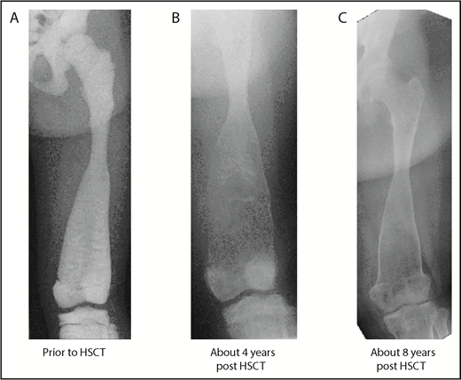 Figure 1. Baseline and follow-up plain radiography of the left lower extremity (femur) of patient 3. (A) Before HSCT, highly increased bone density with significantly diminished radiograph transparency, “ballooning,” especially of the distal femoral diaphysis, and meta/epiphysis. Transversal intraosseous dense horizontal lines are seen. (B) About 4 years after HSCT regression/normalization of bone density, however, decreased cortical lining and even increased osseous “ballooning” is seen. (C) About 8 years after HSCT, remodeling of bone size and complete normalization of cortical thickness is seen.