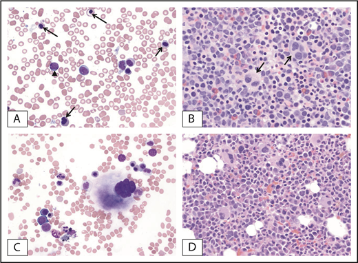Figure 7. Morphologic clearance of dysplastic features at the time of complete remission and NPM1 mutation clearance. (A) Pretreatment BM from a patient with MDS-EB with NPM1 mutation. Dysplastic erythroblasts (arrows) and granulocytes with increased blasts (arrowhead) are observed. (B) Dysplastic megakaryocytes (arrows) within a hypercellular BM. (C-D) Posttreatment BM of the same patient at the time of mutation clearance demonstrates clearance of blasts and regenerating hematopoietic cells without dysplastic changes. Original magnification ×500; Wright-Giemsa (A,C) and hematoxylin and eosin (B,D) stains.
