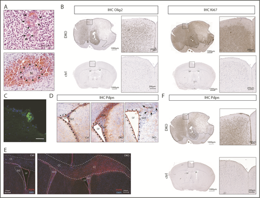 Figure 1. Pten and p53 deletion in neural stem cells leads to development of gliomas with high PDPN expression and intratumoral platelet aggregates. (A) Histopathological features of gliomas developed in DKO mice. Sections were stained with hematoxylin and eosin (H&E). Arrows indicate areas of microvascular proliferation. Arrowheads indicate a necrotic area (N) surrounded by hemorrhage. Scale bars, 50 µm. (B) OLIG2 and Ki67 expression (brown) in brain sections from a glioma-bearing DKO mouse and from a control (ctrl) tumor-free mouse detected by immunohistochemistry. The sections were counterstained with hematoxylin. Dotted lines show tumor mass. (C) Immunofluorescence staining of CD41 (green) of a tumor area from a DKO mouse. Cellular nuclei are stained with DAPI and pseudocolored in blue. Scale bar, 50 µm. (D) PDPN expression (red) detected by immunohistochemistry of brain sections from: ctrl, DKO, and TKO mice euthanized 2 weeks after oil injection (for control), and tamoxifen-induced transgenes recombination (for DKO and TKO). The brain sections show the SVZ of the LV and RMS. Arrowheads indicate ependymal cells. Arrows indicate areas of residual PDPN expression in TKO mice. Sections were counterstained with hematoxylin. Scale bars, 100 µm. (E) Immunofluorescence staining for PDPN of brain sections from a ctrl and DKO mouse euthanized 4 months after oil injection and tamoxifen-induced p53 and pten deletion, respectively. Cellular nuclei are stained with DAPI and pseudocolored in blue. Dashed lines show corpus callosum (CC). Dotted lines show SVZ. (F) PDPN expression (brown) in a brain section from a glioma-bearing DKO mouse and from a ctrl tumor-free mouse detected by immunohistochemistry. The sections were counterstained with hematoxylin. Dotted lines show tumor mass.