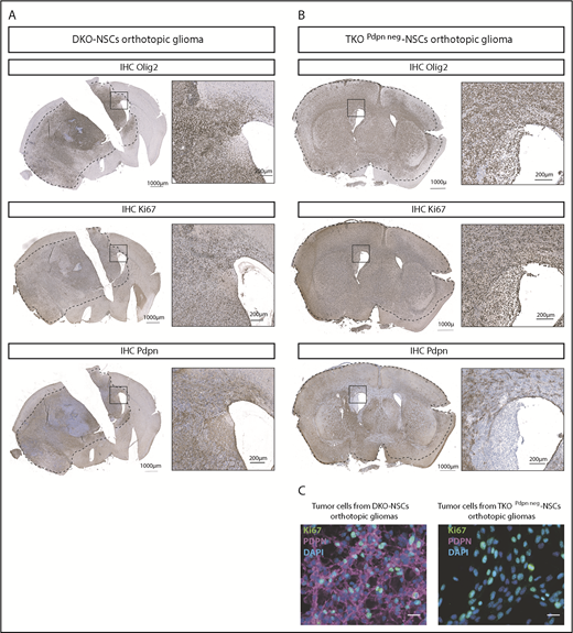 Figure 3. PDPN+ and PDPN− orthotopic gliomas resemble human GBM features. OLIG2, Ki67, and PDPN expression (brown) in brain sections from DKO-NSCs (A) and TKOPdpn neg-NSCs (B) orthotopic gliomas detected by immunohistochemistry. The sections were counterstained with hematoxylin. (C) Immunofluorescence staining for Ki67 and PDPN of tumor cells isolated from mice transplanted orthotopically with either DKO-NSCs or TKOPdpn neg-NSCs. Cellular nuclei are stained with DAPI and pseudocolored in blue. Scale bars, 25 µm.