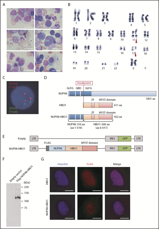 Figure 1. Identification of a novel HBO1-fusion in a patient with CMML. (A) BM smear from the patient with CMML. Scale bar, 20 µm (original magnification ×1000; Wright-Giemsa stain). (B) G-banding karyotyping analysis of BM cells from the patient with CMML. Red triangles indicate the location of chromosomal translocation. (C) FISH analysis of BM cells from the patient with CMML. (D) Schematic of the CMML patient-derived NUP98-HBO1 fusion. (E) Schematic of the retrovirus vectors. (F) Expression of the NUP98-HBO1 fusion product in 293T cells. (G) Localization of the NUP98-HBO1 fusion protein. HeLa cells were transfected with the indicated vectors 24 hours before immunofluorescence staining. Scale bar, 20 µm (original magnification ×1000; immunofluorescence stain).