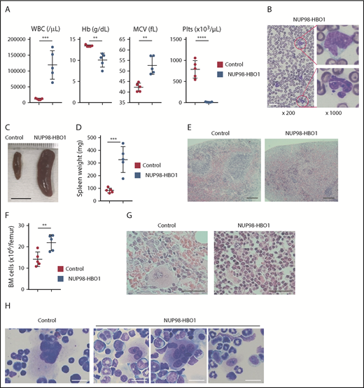 Figure 2. Clinically relevant CMML phenotypes in the patient-derived NUP98-HBO1 BMT mice. (A) White blood cell (WBC) counts, hemoglobin (Hb), mean corpuscular volume (MCV), and platelet (Plts) counts in PB from the control mice transplanted with empty vector transduced cell (Control) and NUP98-HBO1 BMT mice (NUP98-HBO1) at 8 to 10 weeks after transplantation (n = 5 per group). Data are presented as mean ± standard deviation (SD). (B) Diff-Quick (Modified Giemsa) staining of PB smear from the NUP98-HBO1 BMT mice. Scale bar, 20 µm. (C-D) Representative images (C; scale bar, 10 mm) and weight (D) of the spleen from the control and NUP98-HBO1 BMT mice. Data are presented as mean ± SD. (E) Spleen sections from the control and NUP98-HBO1 BMT mice. Scale bar, 200 µm (original magnification ×40; hematoxylin and eosin stain). (F) BM cellularity in the indicated mice. (G) BM sections from the control and NUP98-HBO1 BMT mice. Scale bar, 40 µm (original magnification ×200; hematoxylin and eosin stain). (H) BM cells from the control and NUP98-HBO1 BMT mice. Scale bar, 20 µm (original magnification ×1000; Diff-Quick stain). **P < .01, ***P < .001, ****P < .0001.