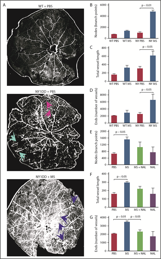 Figure 1. Morphine (MS) induces retinal neovascularization in sickle mice, which is attenuated by coadministration of opioid antagonist naloxone (NAL). (A-D) C57BL/6 mice (WT) or NY1DD sickle mice treated with phosphate-buffered saline (PBS) or increasing doses of MS for 15 months. (E-G) NY1DD sickle mice treated with MS alone, MS with NAL, or PBS with saline or NAL for 10 months. (A) Representative images of isolated retinae with ADPase staining of blood vessels (magnification ×400). NY1DD sickle mice treated with PBS had typical hairpin loops in the periphery (green arrows) and few arteriovenous (AV) anastamoses (magenta arrows). MS-treated NY1DD sickle mice had more AV anastamoses (blue arrows). The results of statistical analysis of nodes showing vessel branching (B,E), total length of blood vessels (C,F), and total number of blood vessels in retinae are shown (D,G). N = 3 mice per treatment. All values are mean ± SEM, and significance was determined by 1-way analysis of variance, Dunnet’s multiple comparisons.