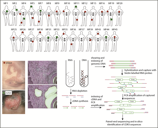 Figure 1. Schematic representation of sample collection, processing, and TCR sequencing. Four-millimeter punch biopsies were collected from early lesions (plaques; red circles) or tumors (green squares) in 27 patients with MF. Biopsies were cryosectioned and laser microdissected to capture tumor cells that were pooled together. Original magnification ×10; hematoxylin and eosin staining. DNA and RNA were isolated simultaneously from the microdissected material and processed for WES and WTS. WTS data are available only for samples MF4_2T, MF4_3P, MF5_1T, MF5_2P, MF7_1T, MF7_2P, MF11T, MF11_1P, MF19_1T, and MF19_2P and a pool of normal CD4+ lymphocytes (data not shown). The gene sequence is indicated in green, the adapter sequence is indicated in red, and the index sequence is indicated in blue.