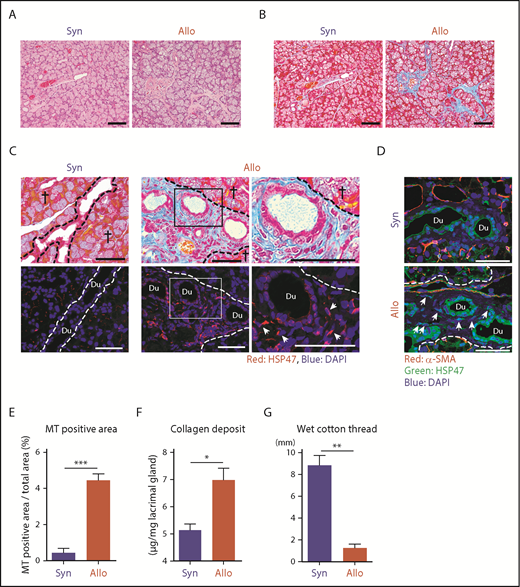 Figure 1. HSP47+ myofibroblasts accumulated in fibrotic lesions of the lacrimal gland after allogeneic BMT. BALB/c mice were transplanted with 8 × 106 BM cells plus 2 × 107 splenocytes from allogeneic (Allo) B10.D2 or syngeneic (Syn) BALB/c donors on day 0, following 6 Gy TBI. Lacrimal glands were harvested on day +35 after BMT. H&E-stained (A) and MT-stained (B) images of the lacrimal glands. Scale bars, 100 μm. (C) MT staining (upper panels) and immunofluorescent images (lower panels) for HSP47 (red), with DAPI nuclear staining (blue) on the pairs of consecutive serial sections. Areas in the rectangles (middle panels) were magnified (right panels). Scale bars, 50 μm. Crosses indicate glandular parenchyma. Arrows indicate HSP47+ fibroblasts. (D) Immunofluorescent staining of HSP47 (green) and α-SMA (red) with DAPI nuclear staining (blue). Arrows indicate HSP47+ myofibroblasts. Scale bars, 50 μm. (E) Proportion of fibrotic area stained with MT compared with the total area of the sections of lacrimal glands from Syn (n = 6) and Allo (n = 9) mice. (F) The amount of collagen deposition in the lacrimal glands from Syn (n = 7) and Allo (n = 7) mice was normalized with tissue weight. Data from 2 independent experiments were combined and are shown as mean ± SEM. (G) The volume of tear secretion was measured as the length of wet cotton threads from Syn (n = 8) and Allo (n = 9) mice on day +35 posttransplant. Data from 2 independent experiments were combined and are shown as mean ± SEM. Dashed lines indicate the borders between the glandular parenchyma and interstitium. *P < .05, **P < .01, ***P < .005. Du, ductal lumen.