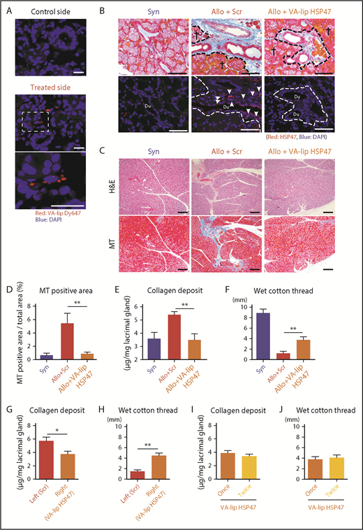 Figure 2. VA-lip HSP47 ameliorates fibrosis of the lacrimal glands in chronic GVHD. Mice were transplanted as in Figure 1. (A) VA-lip Dy647 eye drops were administered daily in 1 eye from day +29 to day +33 after allogeneic BMT. One hour later, the lacrimal glands were harvested from the treated and control sides. Images of VA-lip Dy647 particles (red) with DAPI (blue) counterstaining. The area in the dashed rectangle (middle panel) is magnified (lower panel). Scale bars, 20 μm. (B-F) A group of allogeneic recipients (Allo) was treated with VA-lip HSP47 eye drops from day +2 to day +34, and the lacrimal glands were harvested on day +35 after BMT. VA-lip Scr was administered to Allo control mice. (B) MT staining (upper panels) and immunofluorescent (lower panels) images for HSP47 (red) with DAPI nuclear staining (blue) on pairs of consecutive serial sections. Scale bars, 50 μm. Dashed lines indicate the borders between the glandular parenchyma and interstitium, crosses represent glandular parenchyma; and arrows point to HSP47+ fibroblasts. (C) H&E staining (upper panels) and MT staining (lower panels) of pairs of consecutive serial sections. Scale bars, 100 µm. (D) Proportion of fibrotic area to whole area of the sections of lacrimal glands stained with MT. Data from syngeneic mice (Syn; n = 3), allogeneic controls treated VA-lip Scr (Allo+Scr; n = 6), and allogeneic recipients treated with VA-lip HSP47 (Allo+VA-lip HSP47, n = 9) are shown as mean ± SEM. (E) The amount of collagen deposition in the lacrimal glands from Syn (n = 8), Allo+Scr (n = 9), and Allo+VA-lip HSP47 (n = 8) mice was normalized with the weight of tissues. (F) The volume of tear secretion was measured as the length of wet cotton thread inserted under the lower eyelids on day +35 posttransplant. Data from Syn (n = 3), Allo+Scr (n = 6), and Allo+VA-lip HSP47 (n = 9) mice are shown as mean ± SEM. (G-H) Allogeneic recipient mice (n = 13) were treated with VA-lip HSP47 eye drops in the right eye and VA-lip Scr eye drops in the left eye from day +2 to day +34 after BMT. (I-J) Allogeneic recipient mice were treated with VA-lip HSP47 eye drops once daily (n = 8) or twice daily (n = 8) from day +2 to day +34 after BMT. The amount of collagen deposition in the lacrimal glands (G,I) and the volume of tear secretion (H,J) on day +35 are shown as mean ± SEM. (D-J) Data from 2 independent experiments were combined. *P < .05; **P < .01.
