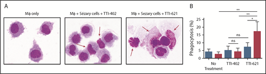 Figure 3. Blockade of CD47 with SIRPαFc (TTI-621) promotes phagocytosis of Sézary cells but not nonmalignant CD4+ cells. (A) Cytospin preparation of representative samples 2 hours after phagocytosis in the presence of an IgG1 isotype control molecule (TTI-402) or TTI-621. Red arrows identify Sézary cells that are external to macrophages in the presence of isotype control but phagocytosed in the presence of TTI-621 (Romanowsky stain; original magnification ×100). (B) Macrophage-mediated phagocytosis of matched nonmalignant (blue) or Sézary cells (red) from 8 patients with SS in media (no treatment), 1 µM TTI-403 (isotype control), and 1 µM TTI-621. One-way analysis of variance with Tukey posttest (*P < .05; **P < .01).