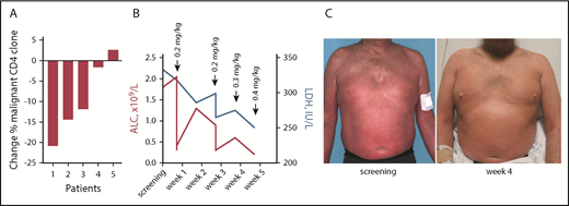 Figure 5. Clinical benefit of TTI-621 in Sézary syndrome is accompanied by a decrease in circulating clone of Sézary cells. (A) Percentage change in clonal (Vβ+) CD4 cells in patients with Sézary syndrome (n = 5) who received a single dose of TTI-621. Comparison between day 1 pretreatment and 8 days after infusion. (B) Decrease in lactate dehydrogenase (LDH; right y-axis, blue) and absolute lymphocyte count (ALC; left y-axis, red) during treatment with TTI-621 (a representative patient). (C) A 52-year-old man with stage IVA1 (T4N1M0B2) SS enrolled in phase 1a of clinical trial NCT02663518. Images taken at screening and week 4 on study.