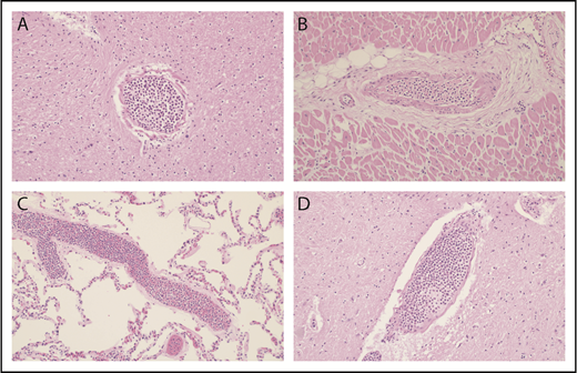 Figure 1. Multiorgan leukostasis (case 1). Hematoxylin and eosin–stained sections (original magnification ×20) taken from autopsy showed severe diffuse leukostasis in the brain (A), heart (B), lungs (C), and spinal cord (D). Additionally, the spleen, liver, colon, and uterus displayed similar findings with evidence of ischemia and end-organ damage (not shown).